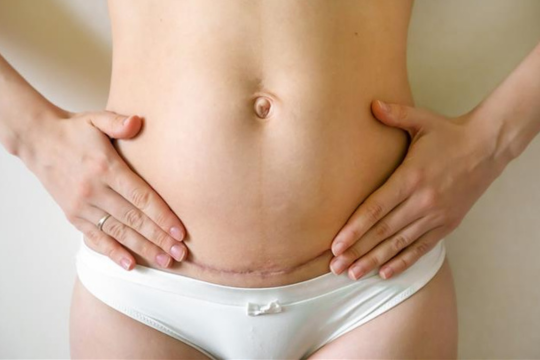 C-section recovery week by week guide